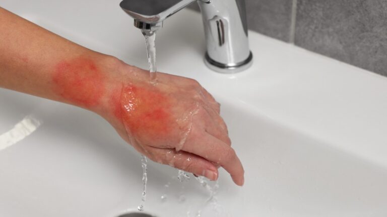 Forearm with red, irritated burn being rinsed under a running faucet in a sink